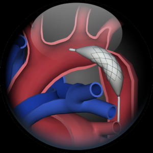 3D Road Map to Congenital Heart Disease для Мак ОС